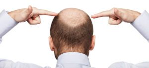 7 Gründe gegen eine Haartransplantationen