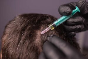 PRP-Behandlung für volles und gesundes Haar – Ein Weg zur Haarwiederherstellung