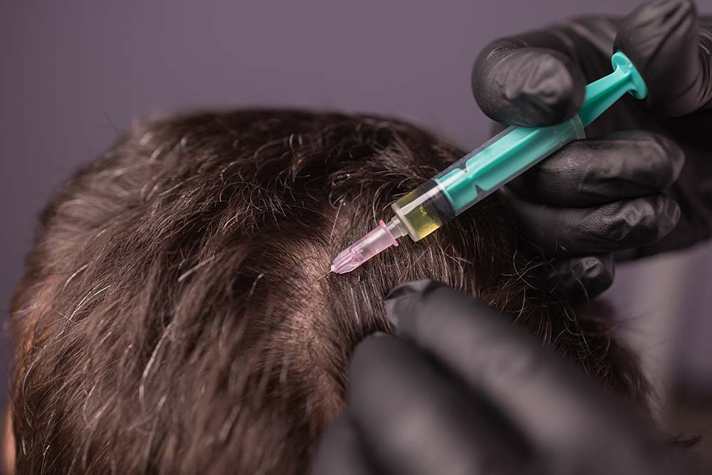 PRP-Behandlung für volles und gesundes Haar – Ein Weg zur Haarwiederherstellung