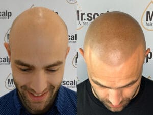 Haarpigmentierung Mister Scalp