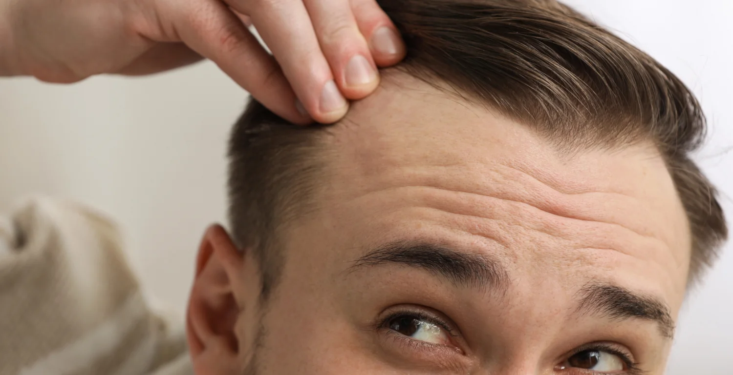 Haarpigmentierung bei Geheimratsecken