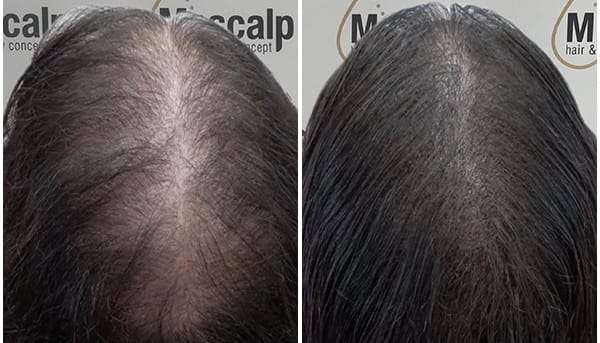 Leistungen Haarverdichtung Mister Scalp