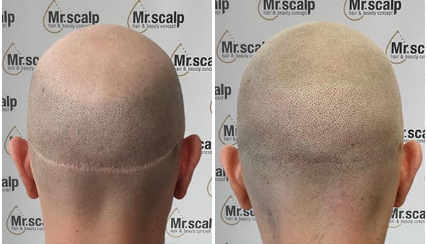 Leistungen Narbenpigmentierung Mister Scalp