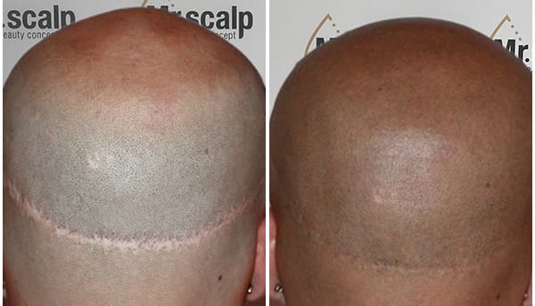 Mikropigmentierung Mister Scalp Haarverdichtung