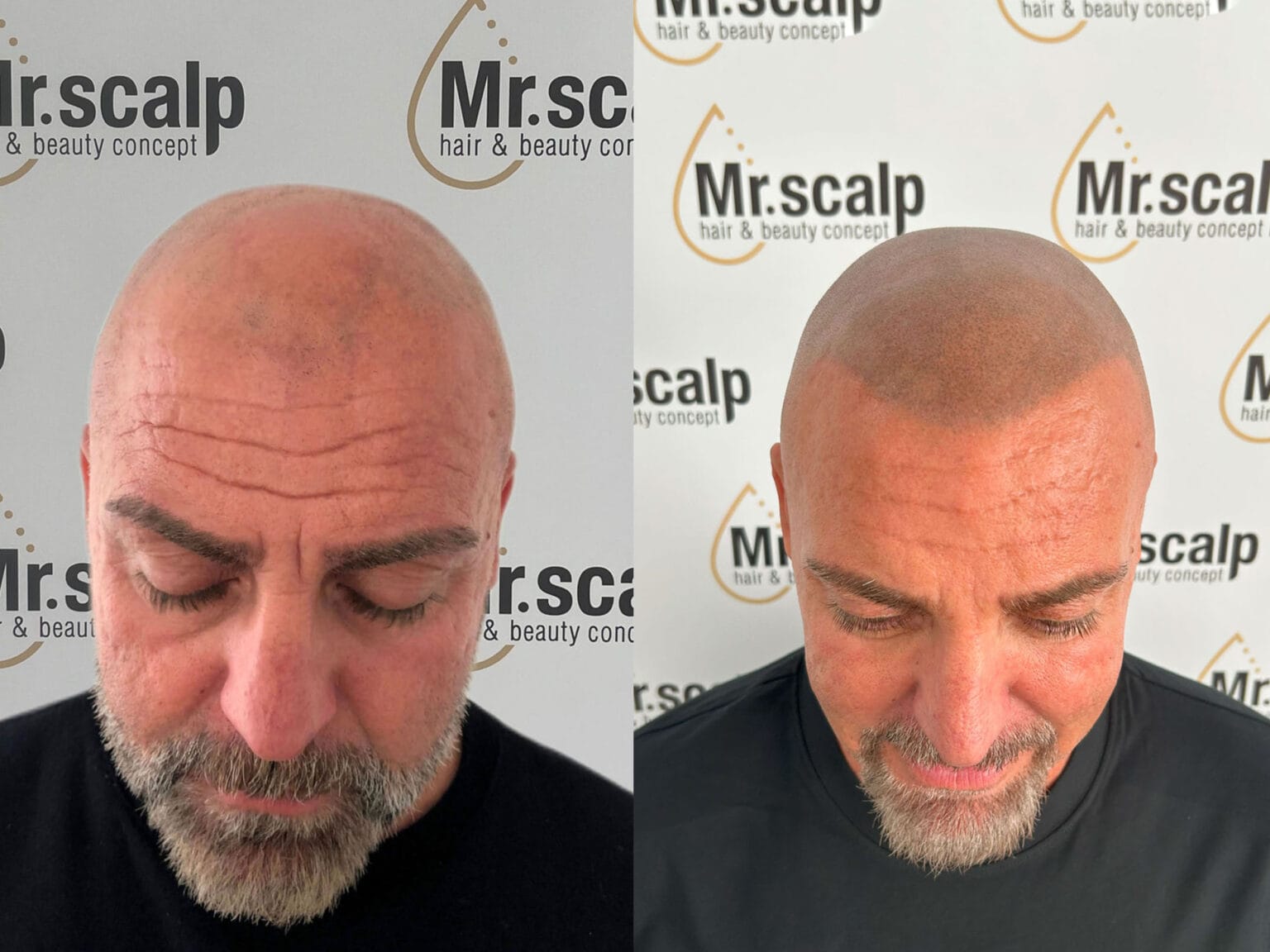 Vorteile Mister Scalp